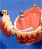 アタッチメント義歯／コーヌクローネ義歯