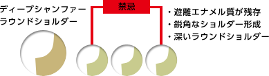 支台歯形成 図